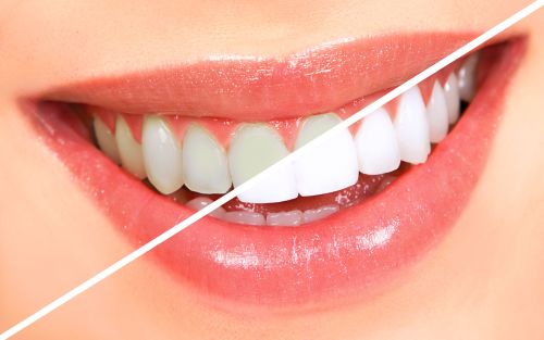 Jak funguje bělení zubů