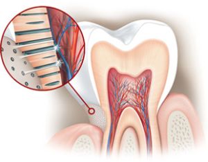 Citlivost při bělení zubů