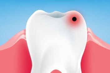 Nejčastější onemocnění zubů