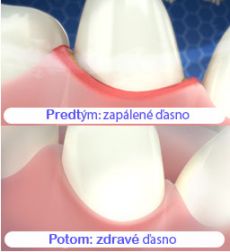 Zanícená dáseň je mírně červená a ustupuje. Zánět dásní způsobuje i odhalování zubních krčků.